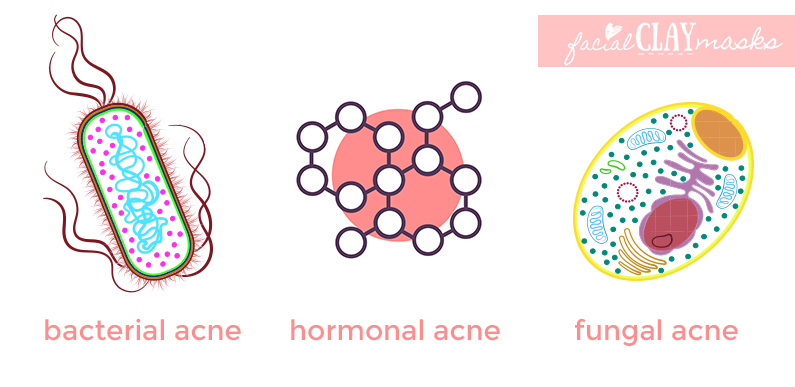 Acne 101: What are the Different Types of Acne? 8