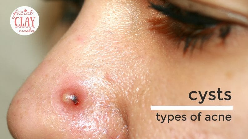 Acne 101: What are the Different Types of Acne? 7