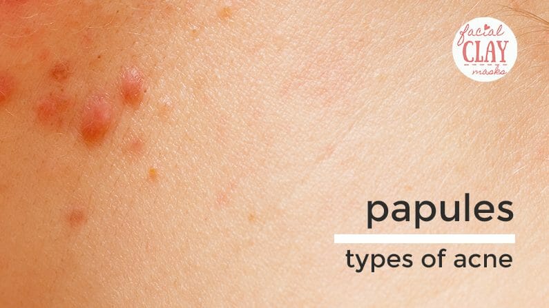 Acne 101: What are the Different Types of Acne? 4