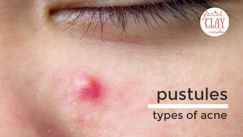 Acne 101: What are the Different Types of Acne? 5