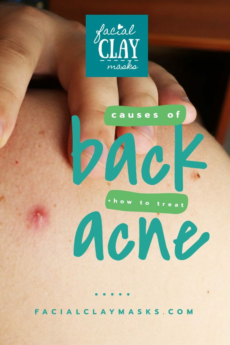 Causes of Back Acne
