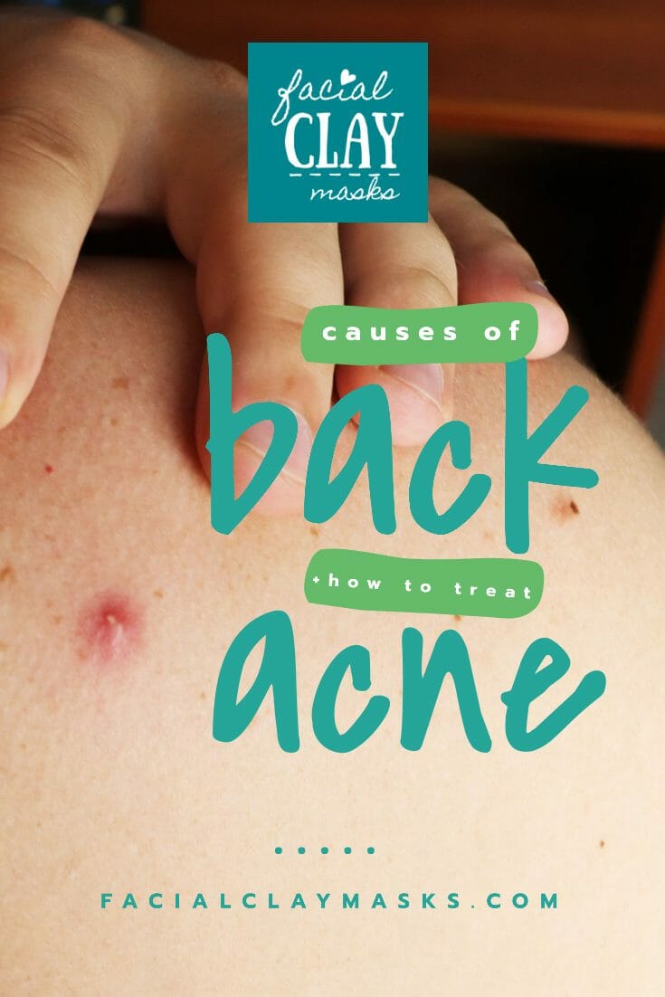 What Are The Causes Of Back Acne How To Treat Back Acne