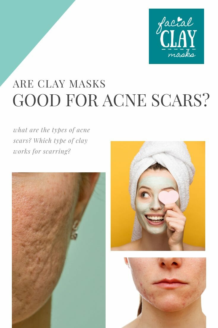 How to Use Clay for Acne Scars 1